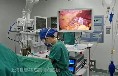 [General Surgery Laparoscopy] 4K Ultra HD Laparoscopic Radical Left Hemicolectomy