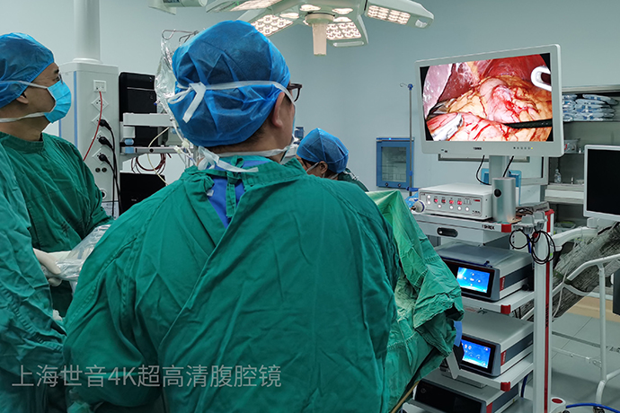 [General Surgery Laparoscopy] 4K ultra-high definition laparoscopic sleeve gastrectomy